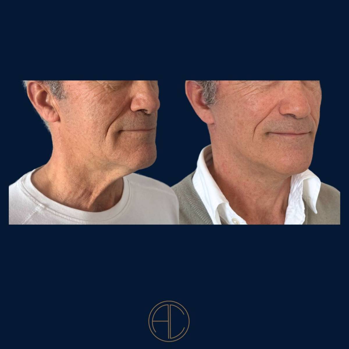 Lifting cervico-facial à Marseille par le Dr Chossat