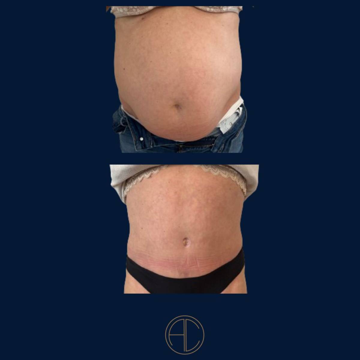 Abdominoplastie à Marseille par le Dr Chossat